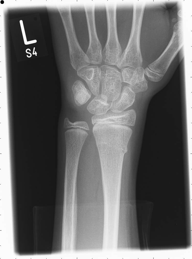 Posterior-anterior (PA) and lateral radiographic images of the left wrist.