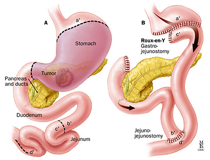 Image result for total gastrectomy roux-en-y oesophago-jejunal anastomosis 
