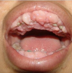 نتيجة بحث الصور عن ‪gum cancer‬‏