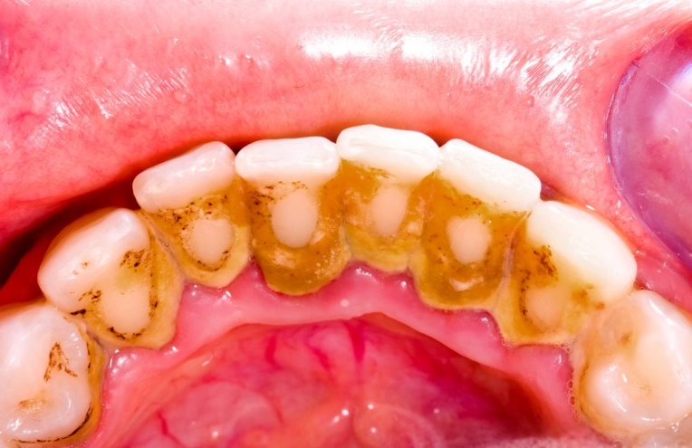 dental-plaque-1024x663.jpg