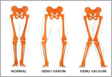 Image result for varus knee