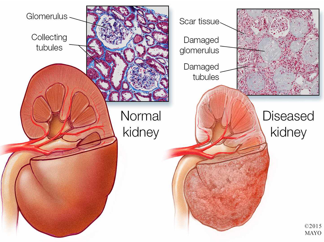 Image result for chronic kidney disease