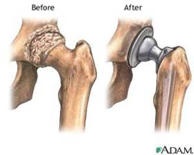 Medical Titanium Hip Replacement